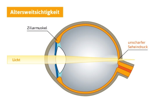 alterssichtiges Auge