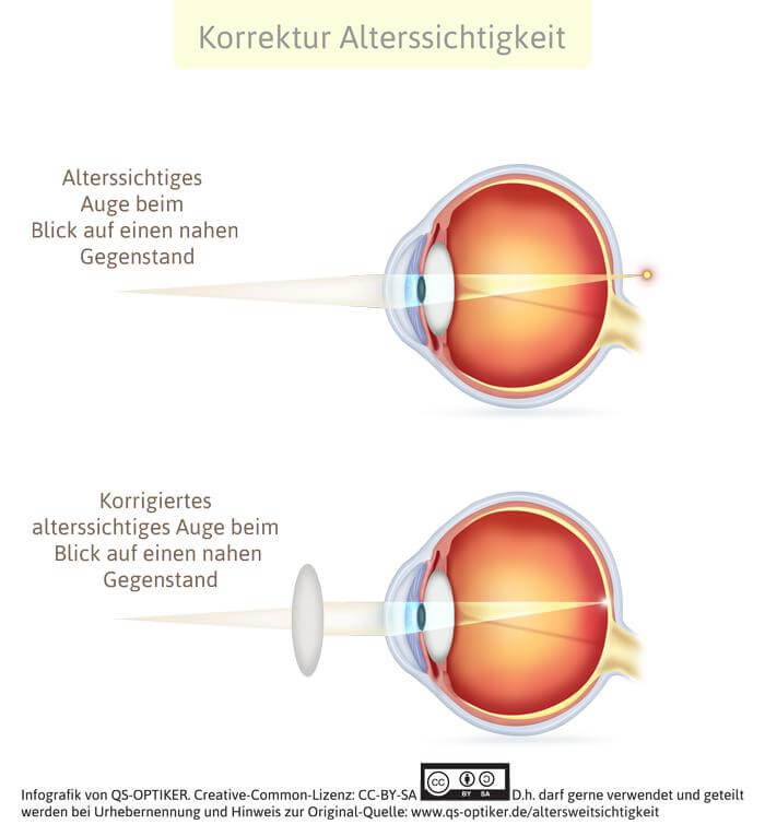 Korrektur Altersweitsichtigkeit