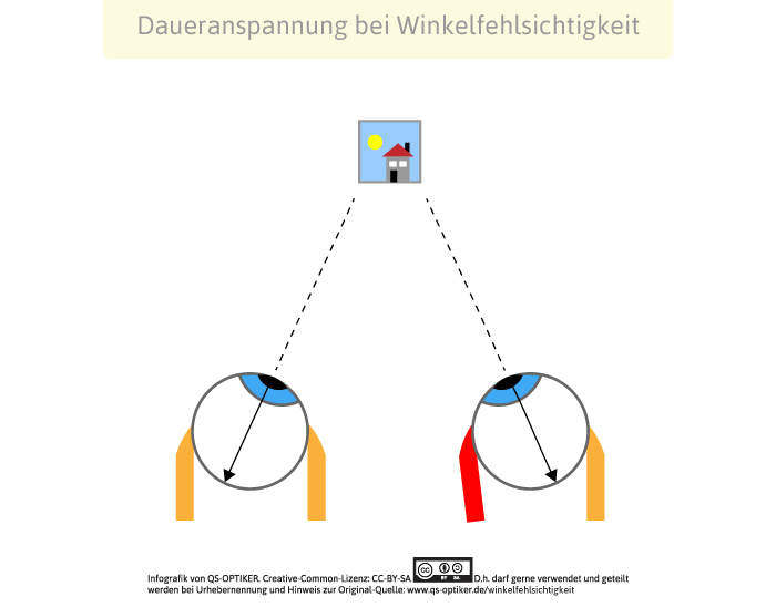 Daueranspannung bei Winkelfehlsichtigkeit