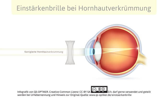 Einstärkenbrille bei Hornhautverkruemmung