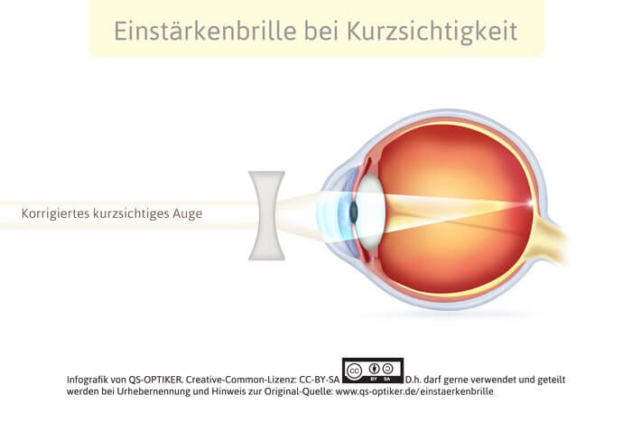 Einstärkenbrille bei Kurzsichtigkeit