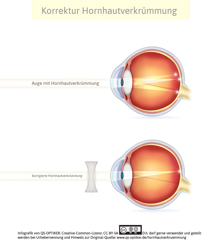 Hornhautverkrümmung Auge - Korrektur