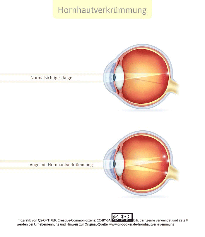 Hornhautverkr mmung Astigmatismus QS OPTIKER