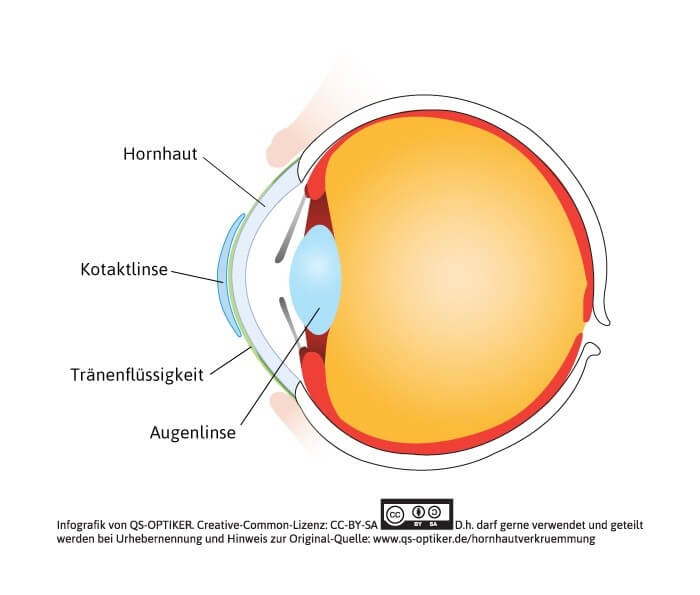 Hornhautverkrümmung - harte Kontaktlinsen