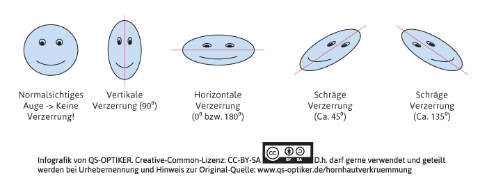 Hornhautverkrümmung Kinder - Verzerrungen