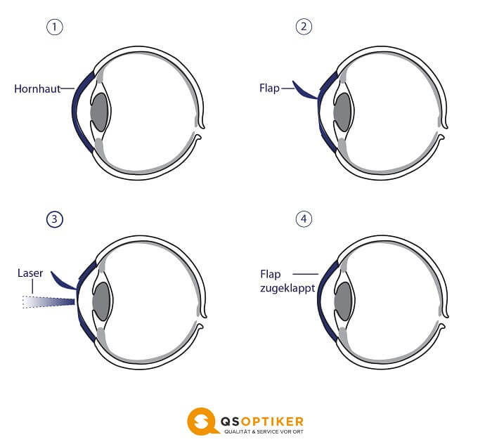 Hornhautverkrümmung - Lasern