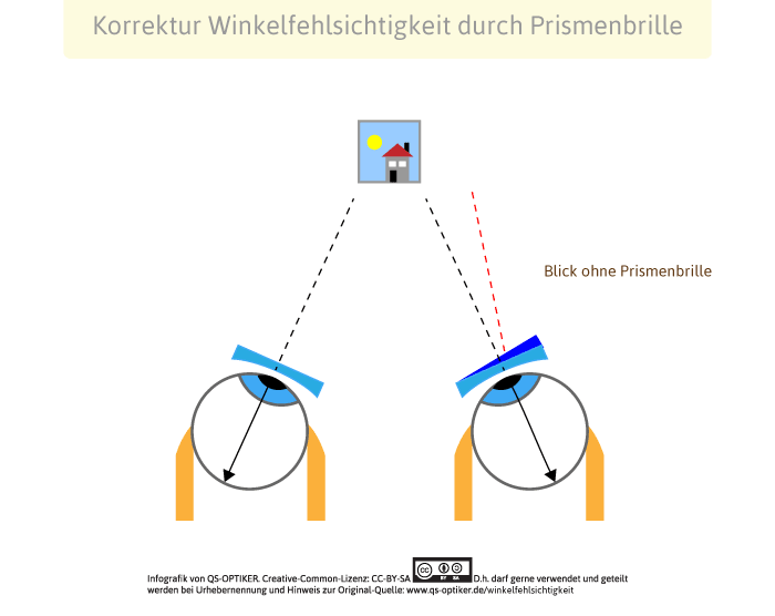 Korrektur Winkelfehlsichtigkeit durch Prismenbrille