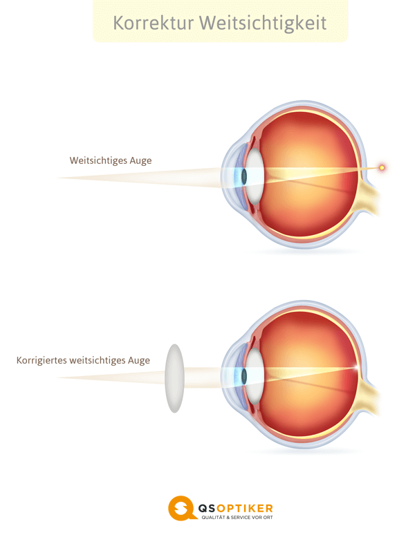 Korrigiertes Weitsichtiges Auge