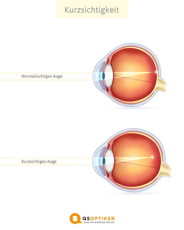 kurzsichtiges Auge