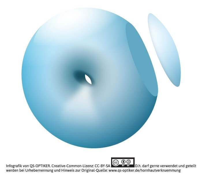 Torische Linsenoberfläche als „Käppchen“