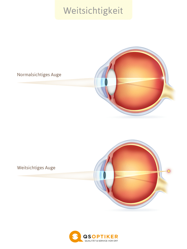 Weitsichtiges Auge