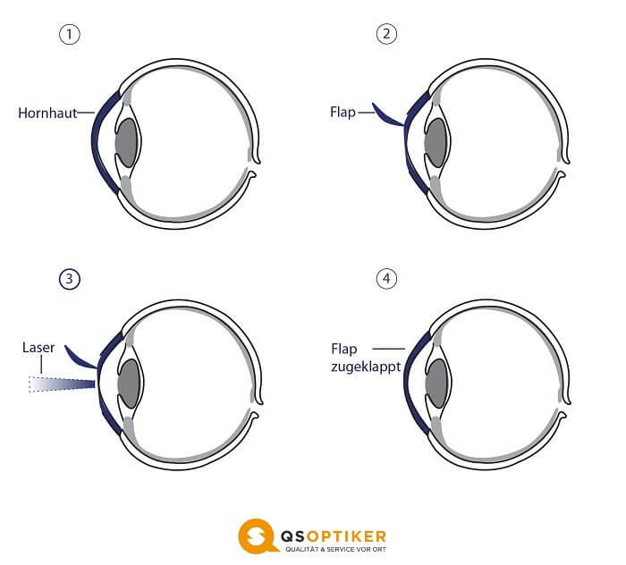 Korrektur der Weitsichtigkeit mit dem LASIK-Verfahren