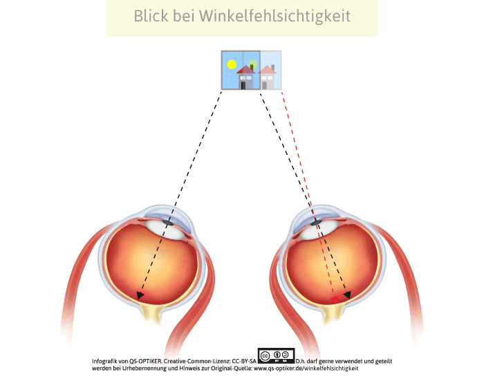 Blick bei Winkelfehlsichtigkeit